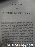 'Removal of the entire lower jaw'