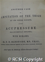 'Another case of amputation of the thigh at its upper fourth, in which acupressure was successfully employed'